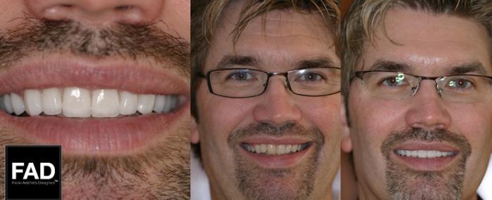 a male patient's before and after pictures