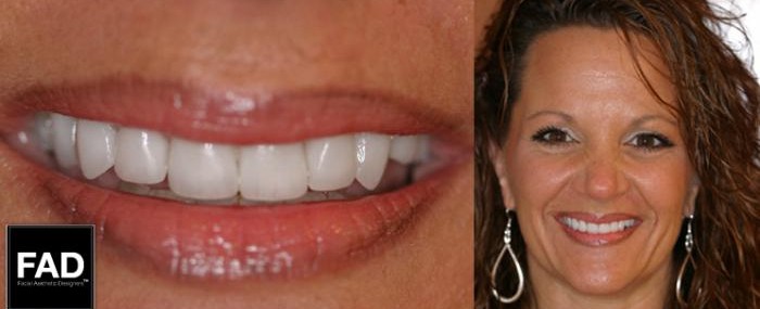 after picture of a patient's smile