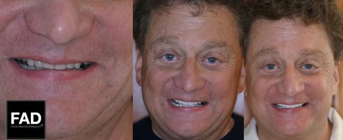 a patient's smile makeover before and after