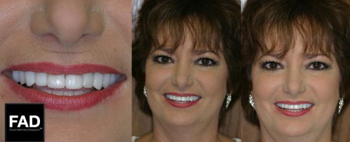 a woman's smile makeover before and after pictures