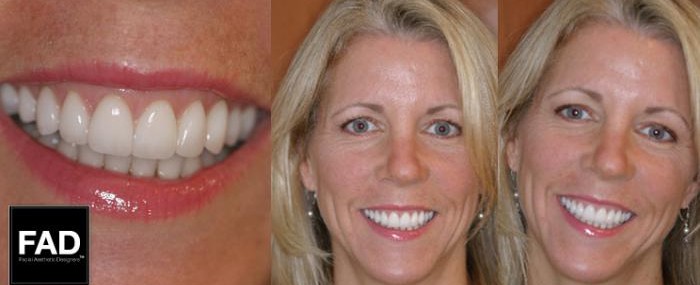 pictures of a blonde patient's smile transformation