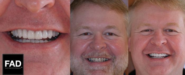 before and after pictures of a patient's smile makeover