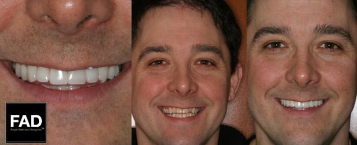 before and after pictures of a smile makeover