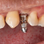 dental implant in the mouth