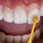 porcelain veneer being attached to tooth