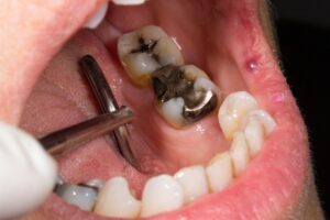Close-up of a dental examination showing a decayed filling in a patient's tooth, highlighting the need for dental restoration and replacement.