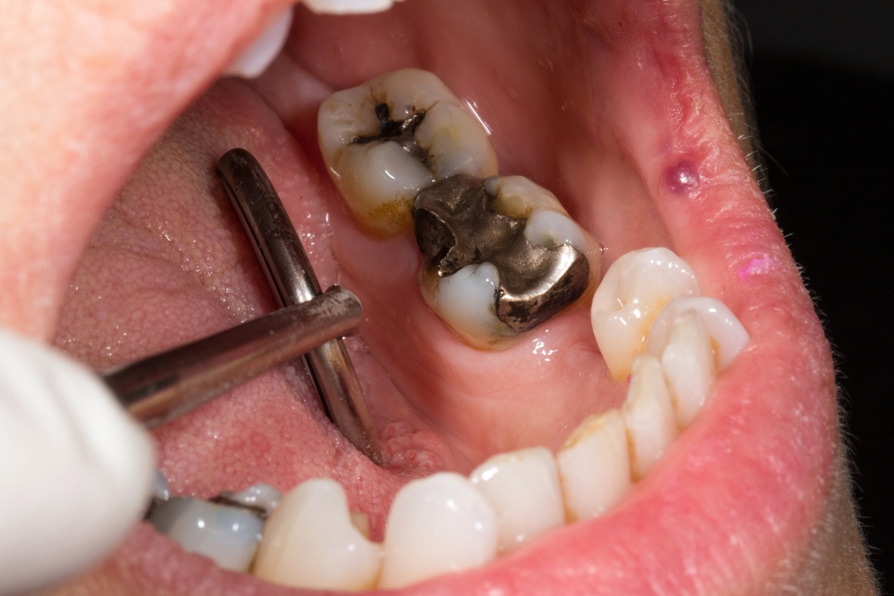 Close-up of a dental examination showing old metal fillings and surrounding teeth, highlighting the need for dental care and potential replacement options.
