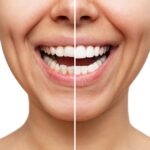 before and after smile makeover