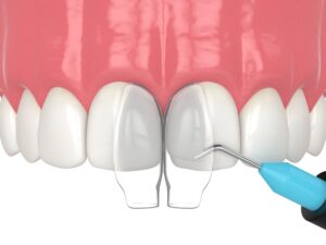 Dental bonding procedure illustration showing composite resin application on front teeth, highlighting tooth preservation and aesthetic enhancement.