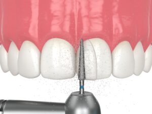 Dental tool preparing tooth surface for bonding procedure, showcasing aesthetic enhancement of teeth with composite resin application.