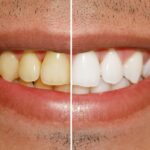teeth whitening before and after