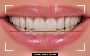 digital smile design