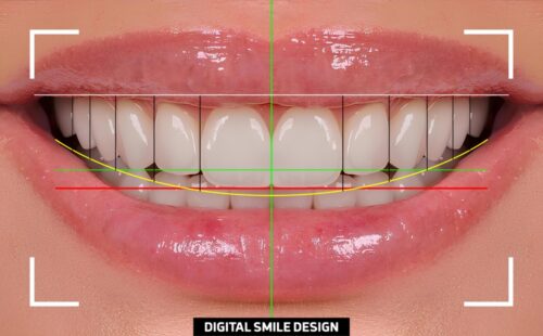 digital smile design