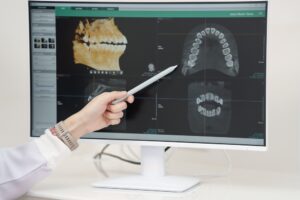 Dental professional pointing at dental X-rays on a computer screen, illustrating the detection of recurrent decay and the assessment of dental restorations.