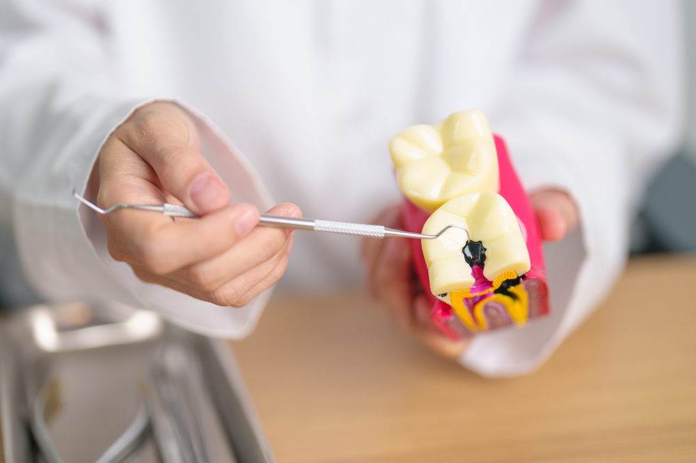 Dentist holding a dental model with a visible cavity, demonstrating oral health issues related to tooth decay.