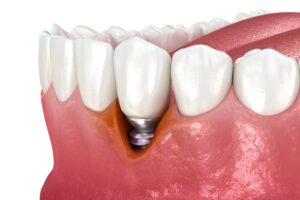 peri-implantitis, exposed dental implant due to gum recession