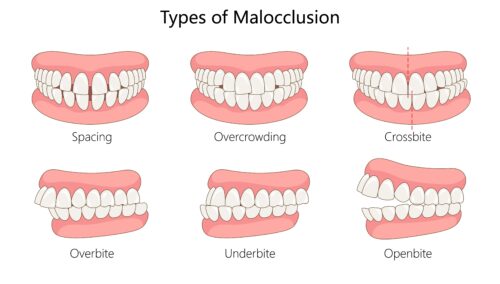 types of malocclusion