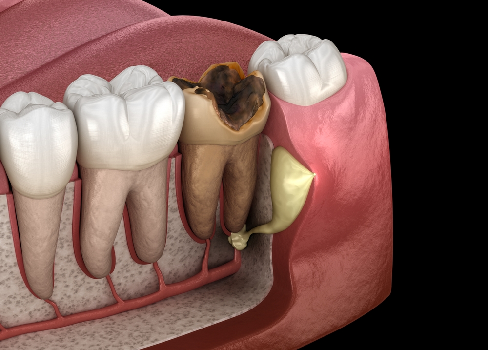 Dental fistula illustration showing infection and damaged tooth
