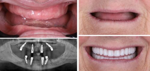 all-on-4 dental implants