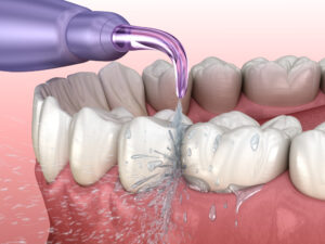 water flosser for cleaning dental implants