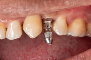 dental implant in the mouth