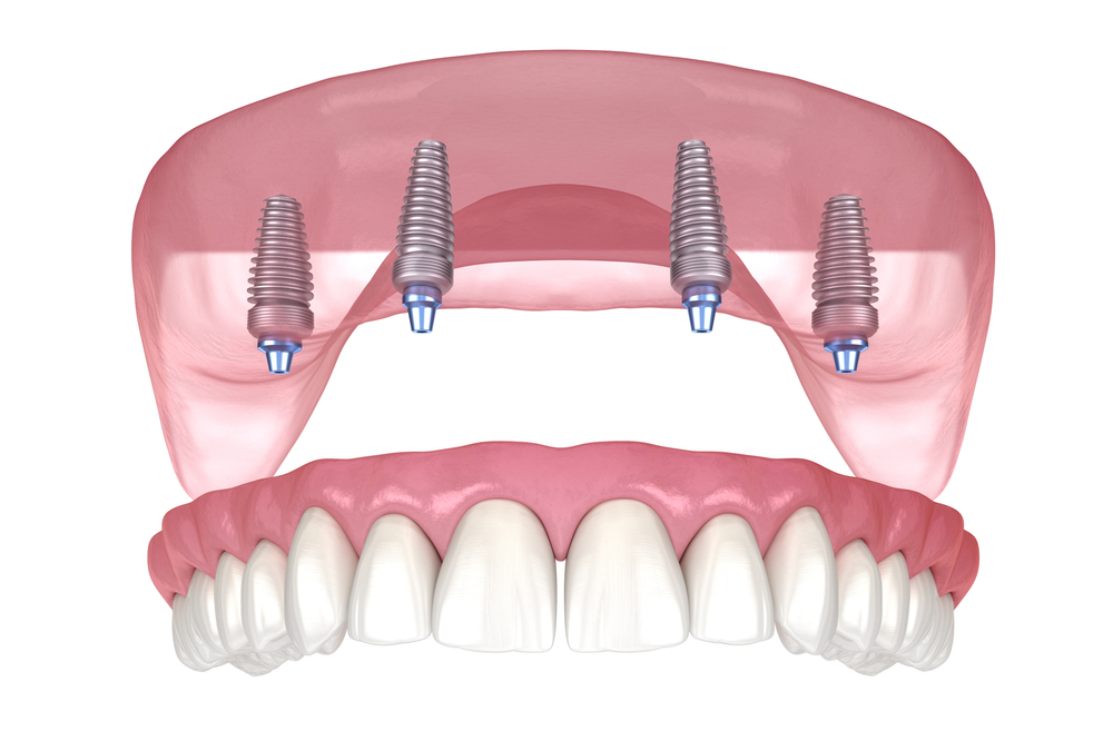 implant-supported denture